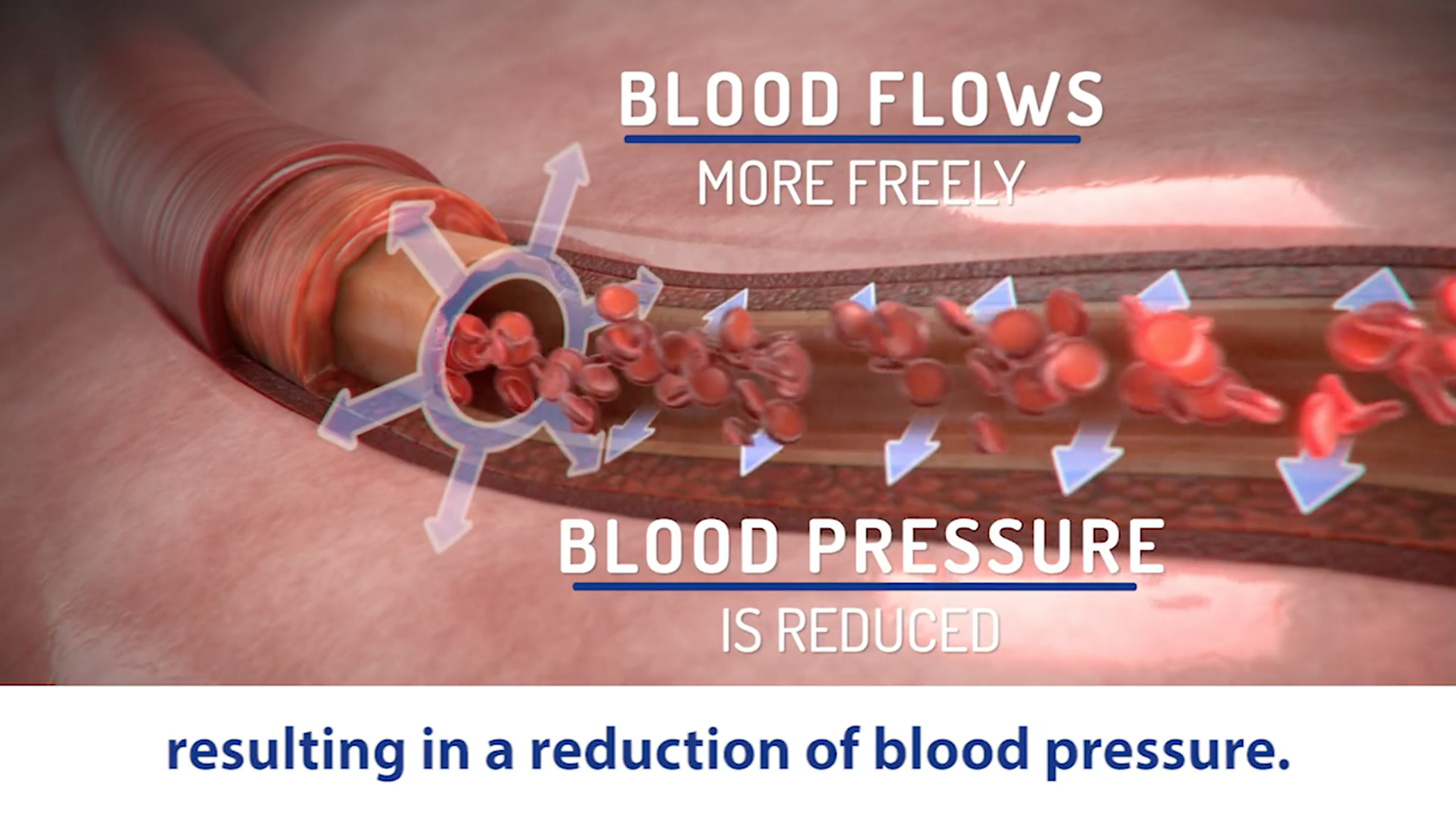 RESPeRATE Ultra RR152-1M Blood Pressure Lowering Device